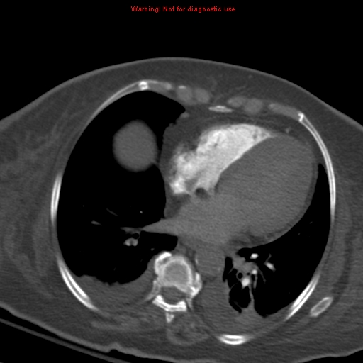 Acute pulmonary embolism (Radiopaedia 13286-13289 Axial C+ CTPA 44).jpg