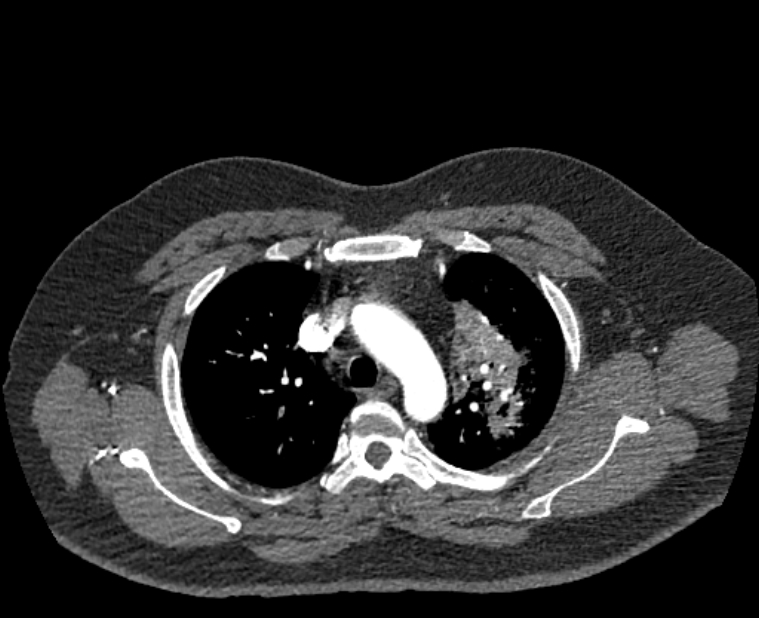 Acute pulmonary embolism with pulmonary infarcts (Radiopaedia 77688-89908 Axial C+ CTPA 14).jpg