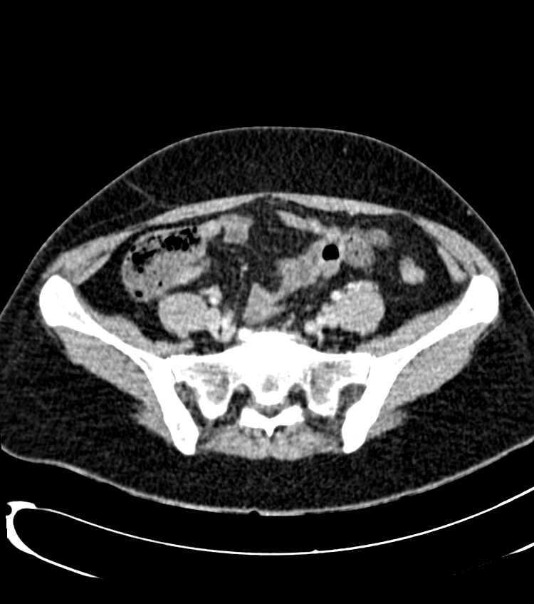 Acute pyelonephritis (Radiopaedia 40264-42816 Axial C+ portal venous phase 51).jpg