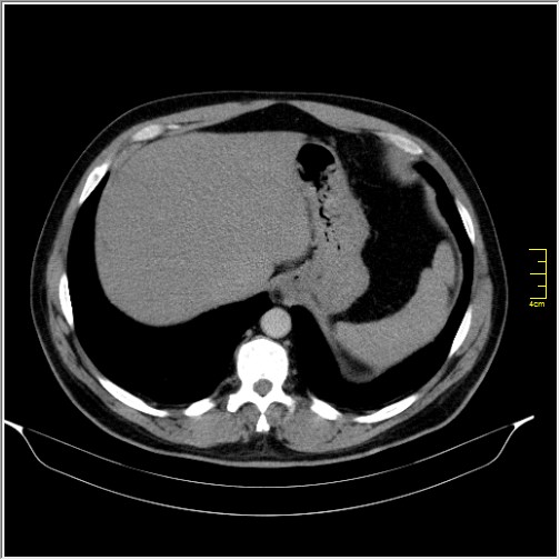 File:Acute right sided diverticulitis (Radiopaedia 65249-74268 Axial C+ portal venous phase 10).JPG