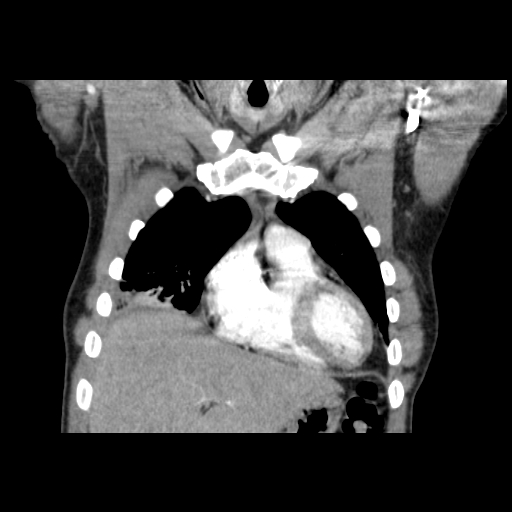 Acute segmental pulmonary emboli and pulmonary infarction (Radiopaedia 62264-70444 Coronal C+ CTPA 9).jpg