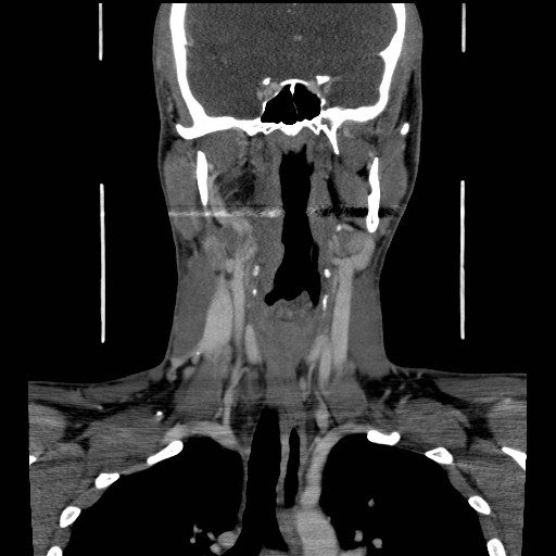 File:Acute submandibular sialadenitis secondary to ductal stone (Radiopaedia 27999-28267 D 30).jpg