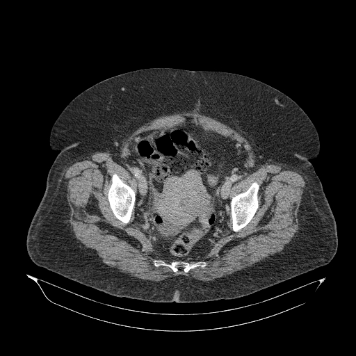 Acute superior mesenteric artery occlusion (Radiopaedia 51288-56960 Axial C+ portal venous phase 89).jpg