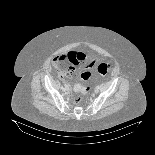 Acute superior mesenteric artery occlusion (Radiopaedia 51288-56960 Axial lung window 61).jpg