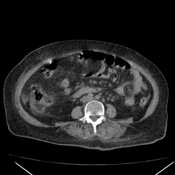 Acute tubular necrosis (Radiopaedia 28077-28334 Axial non-contrast 40).jpg