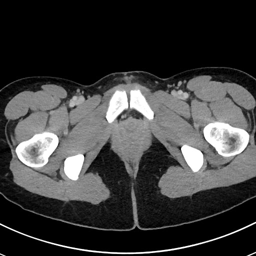 File:Acute uncomplicated appendicitis (Radiopaedia 61374-69304 Axial C+ portal venous phase 136).jpg