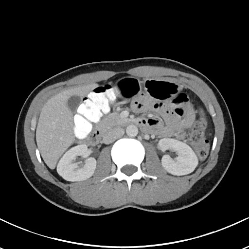 File:Acute uncomplicated appendicitis (Radiopaedia 61374-69304 Axial C+ portal venous phase 44).jpg