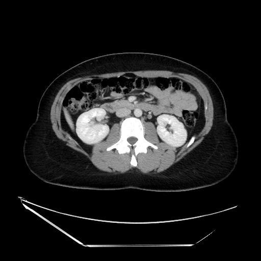 Acute uncomplicated appendicitis (Radiopaedia 73704-84499 Axial C+ portal venous phase 67).jpg