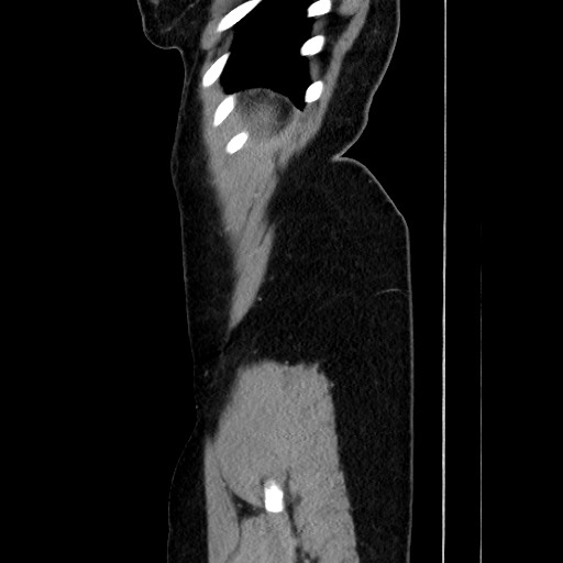 Acute uncomplicated appendicitis (Radiopaedia 73704-84499 Sagittal C+ portal venous phase 179).jpg