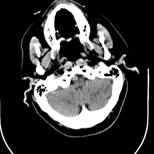 Acute vertebrobasilar ischemic infarction (Radiopaedia 25220-25473 Axial non-contrast 10).jpg