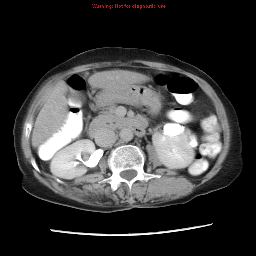 File:Adenocarcinoma of the colon (Radiopaedia 8191-9039 Axial renal excretory phase 17).jpg