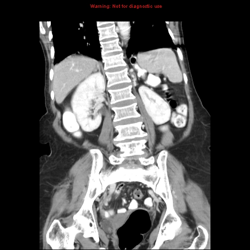 File:Adenocarcinoma of the colon (Radiopaedia 8191-9039 Coronal liver window 31).jpg