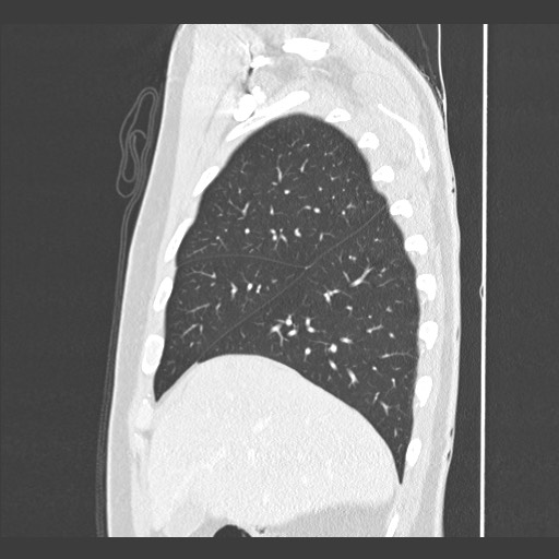 Adenocarcinoma of the lung (Radiopaedia 59871-67325 Sagittal lung window 19).jpg