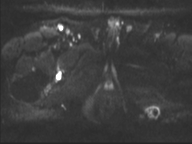 Adenocarcioma of rectum- T1 lesion (Radiopaedia 36921-38546 Axial DWI 3).png
