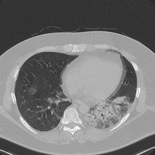 File:Adenoid cystic carcinoma of the trachea (Radiopaedia 49042-54137 Axial lung window 237).jpg