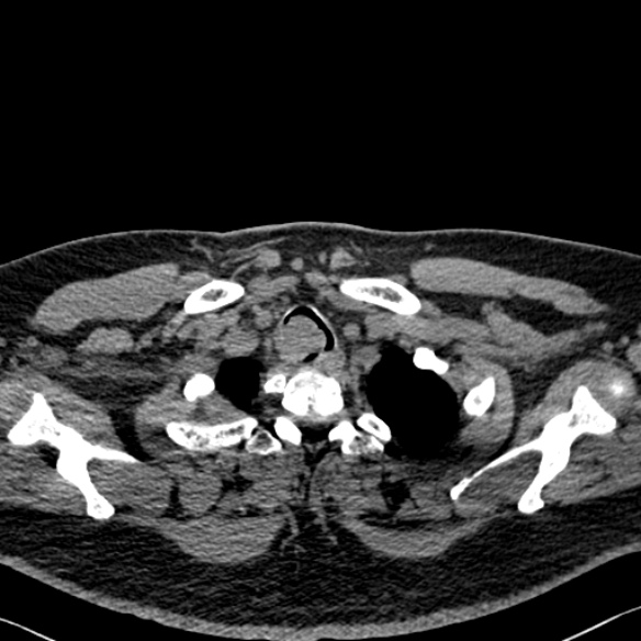 File:Adenoid cystic carcinoma of the trachea (Radiopaedia 49042-54137 Axial non-contrast 26).jpg