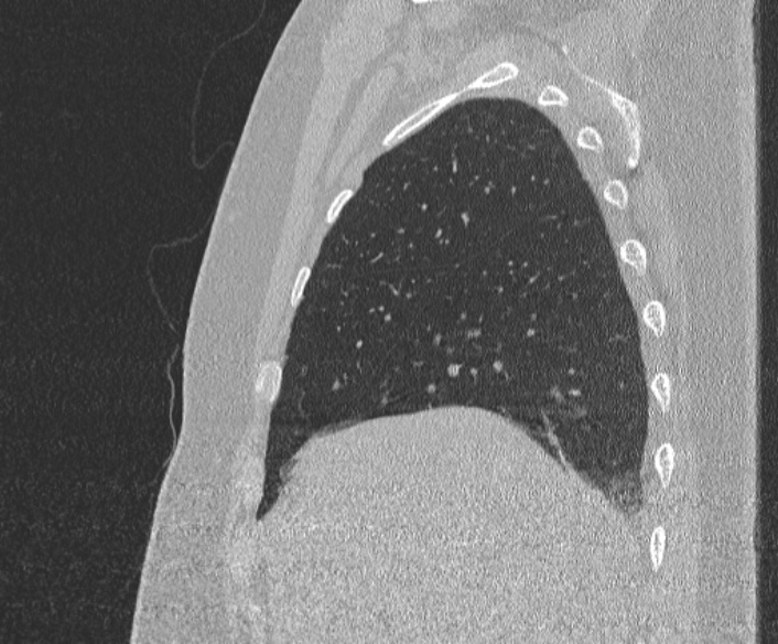File:Adenoid cystic carcinoma of the trachea (Radiopaedia 49042-54137 Sagittal lung window 104).jpg