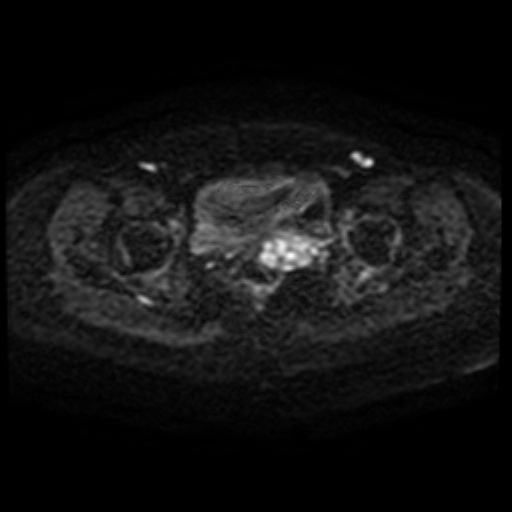 Adenoma malignum of cervix (Radiopaedia 66441-75705 Axial DWI 67).jpg