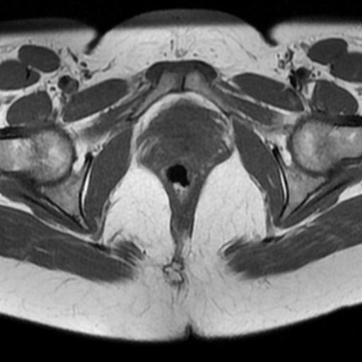 File:Adenoma malignum of cervix (Radiopaedia 66441-75705 Axial T1 16).jpg