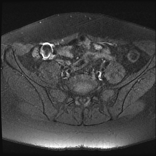 File:Adenomyosis-scar endometriosis (Radiopaedia 65863-75022 Axial T1 fat sat 2).jpg
