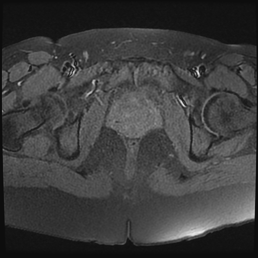 File:Adenomyosis-scar endometriosis (Radiopaedia 65863-75022 Axial T1 fat sat 24).jpg