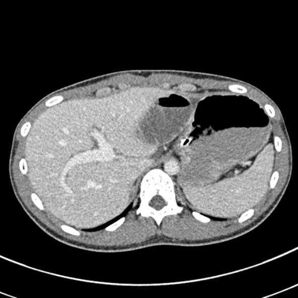 Adhesional small bowel obstruction (Radiopaedia 52107-57980 Axial C+ portal venous phase 21).jpg