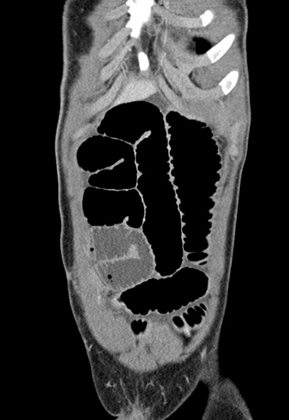 Adhesional small bowel obstruction (Radiopaedia 52107-57980 Coronal C+ portal venous phase 11).jpg