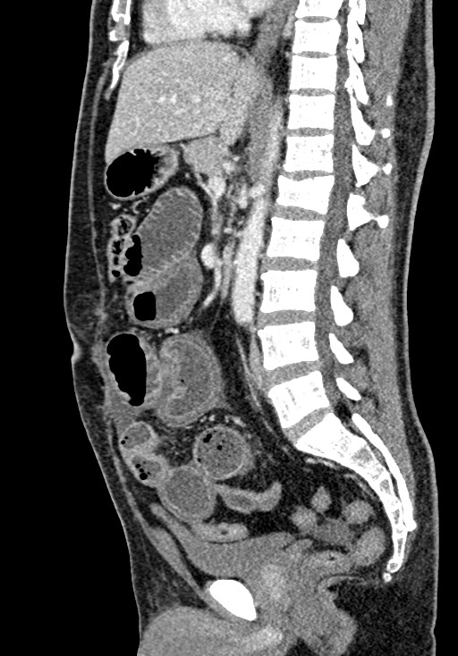 Adhesional small bowel obstruction (Radiopaedia 58900-66131 Sagittal C+ portal venous phase 129).jpg