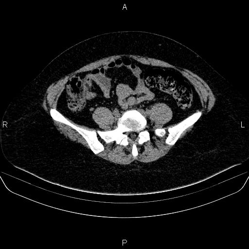 File:Adrenal cortical carcinoma (Radiopaedia 84882-100379 Axial non-contrast 65).jpg