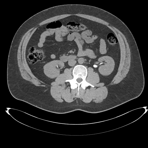 Adrenal cyst (Radiopaedia 45625-49778 Axial non-contrast 60).png