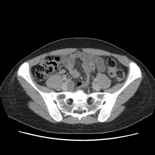 Adrenal cyst (Radiopaedia 64869-73813 Axial C+ portal venous phase 57).jpg