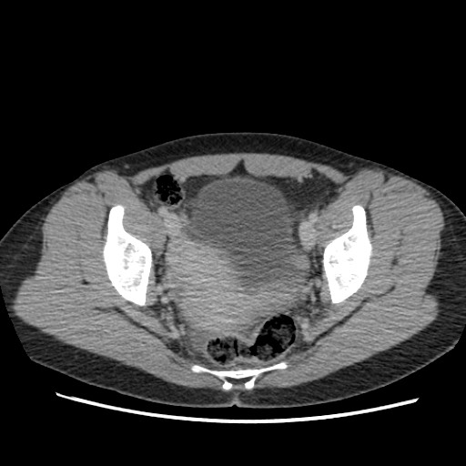 Adrenal cyst (Radiopaedia 64869-73813 Axial C+ portal venous phase 70).jpg