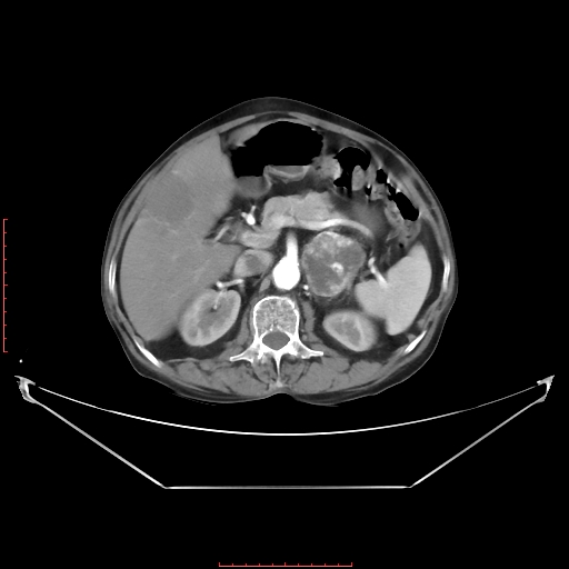 Adrenal hemangioma (Radiopaedia 68923-78668 Axial C+ arterial phase 30).jpg
