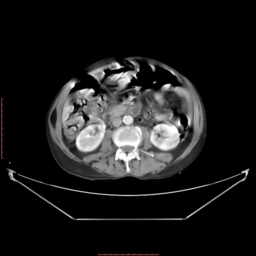 File:Adrenal hemangioma (Radiopaedia 68923-78668 Axial C+ portal venous phase 37).jpg