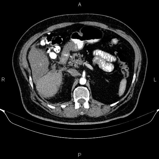 Adrenal hemorrhage (Radiopaedia 62622-70916 Axial C+ arterial phase 137).jpg