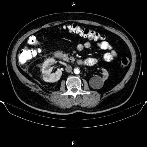 File:Adrenal hemorrhage (Radiopaedia 62622-70916 Axial C+ arterial phase 180).jpg