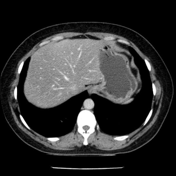 Adrenal myelolipoma (Radiopaedia 43401-46759 Axial C+ portal venous phase 11).jpg