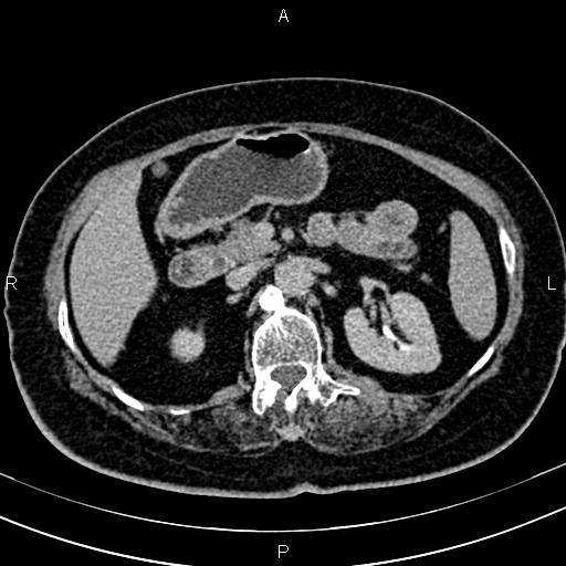 Adrenal myelolipoma (Radiopaedia 82742-96986 Axial renal excretory phase 52).jpg