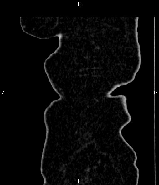 Adrenal myelolipoma (Radiopaedia 82742-96986 Sagittal renal cortical phase 107).jpg
