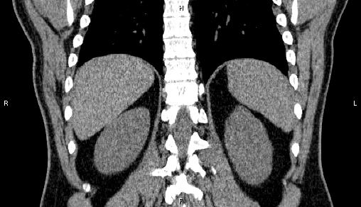Adrenal myelolipoma (Radiopaedia 84321-99619 Coronal non-contrast 61).jpg