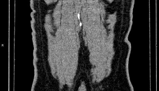 Adrenal myelolipoma (Radiopaedia 84321-99619 Coronal non-contrast 78).jpg