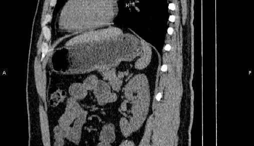 File:Adrenal myelolipoma (Radiopaedia 84321-99619 Sagittal non-contrast 74).jpg