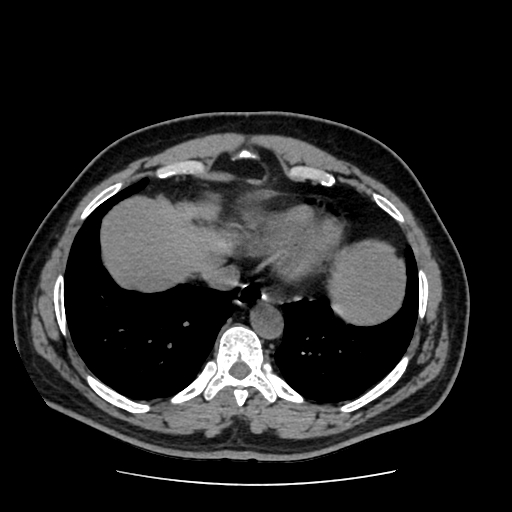 Adrenal myelolipoma and beaver tail liver (Radiopaedia 86201-102193 Axial non-contrast 29).jpg