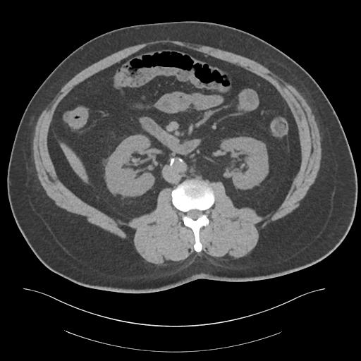 File:Adrenal vein sampling and adrenal nodular hyperplasia - Conn syndrome (Radiopaedia 30561-31337 Axial non-contrast 44).jpg