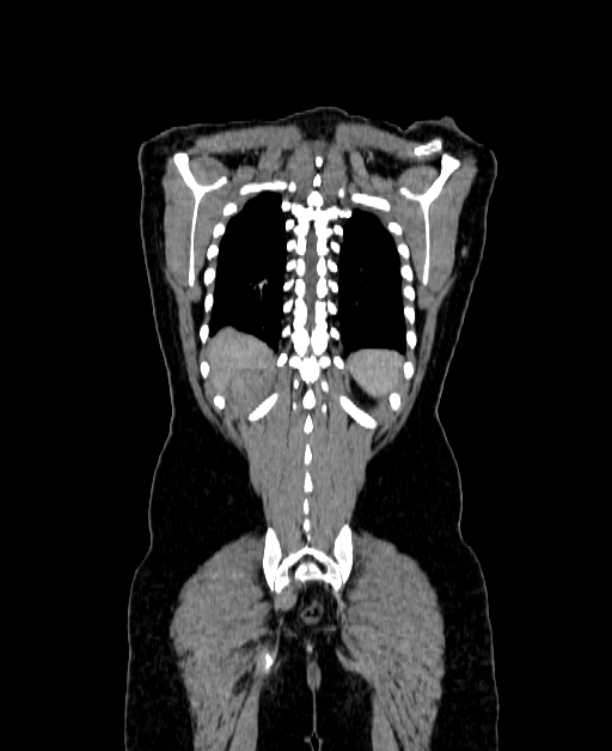 Adrenocortical carcinoma (Radiopaedia 80134-93438 Coronal C+ portal venous phase 140).jpg