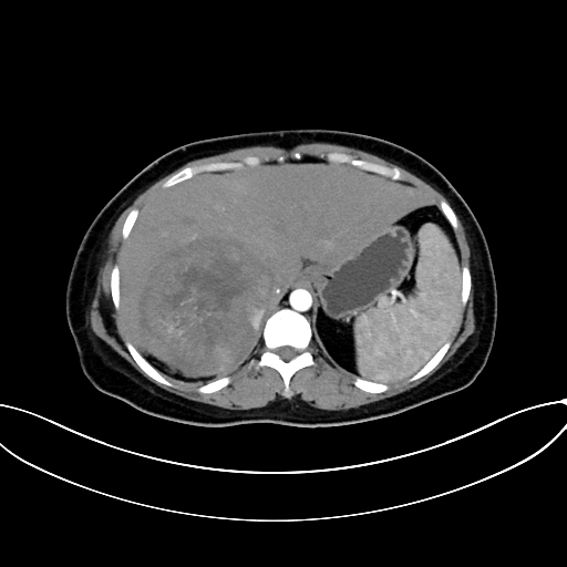 Adrenocortical carcinoma (Radiopaedia 87281-103569 Axial C+ arterial phase 20).jpg