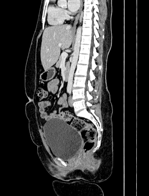 Adrenocortical carcinoma (Radiopaedia 87281-103569 Sagittal C+ portal venous phase 155).jpg