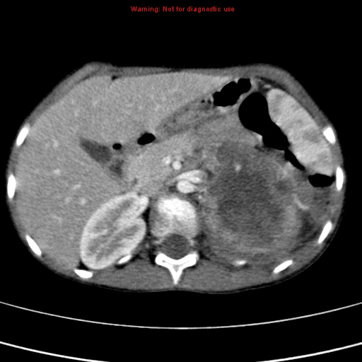 File:Adrenocortical carcinoma (Radiopaedia 9449-10131 Axial C+ portal venous phase 20).jpg