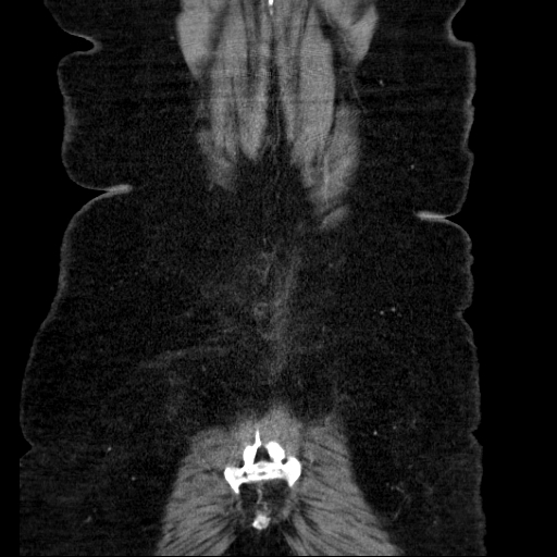 File:Afferent loop syndrome - secondary to incarcerated trocar site hernia (Radiopaedia 82959-97305 Coronal C+ portal venous phase 131).jpg