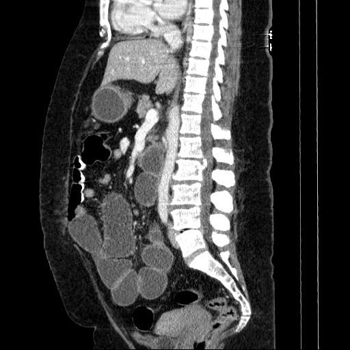 Afferent loop syndrome - secondary to incarcerated trocar site hernia (Radiopaedia 82959-97305 Sagittal C+ portal venous phase 78).jpg